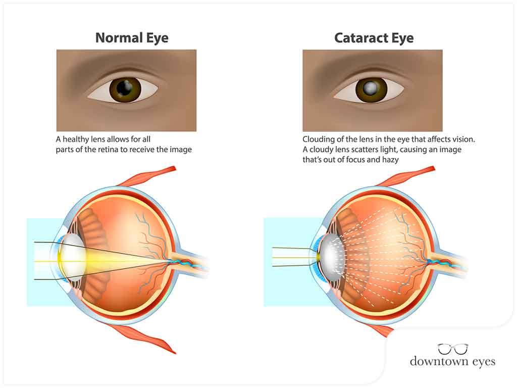 Cataract Treatment - Here To Know!